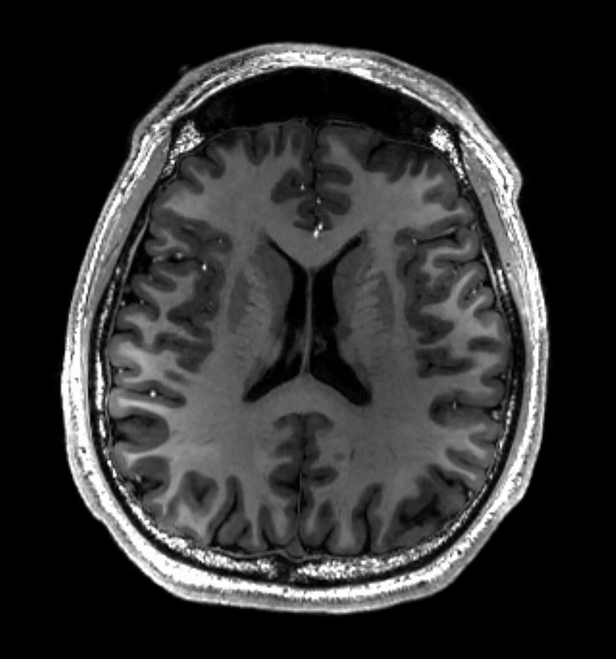 MRI Brain