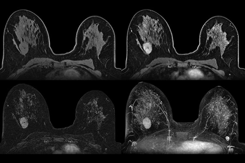 MRI Breast