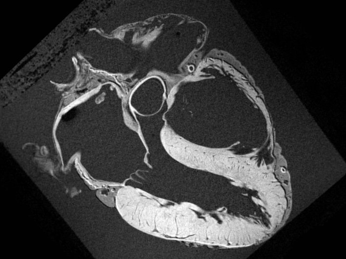 MRI Cardiac