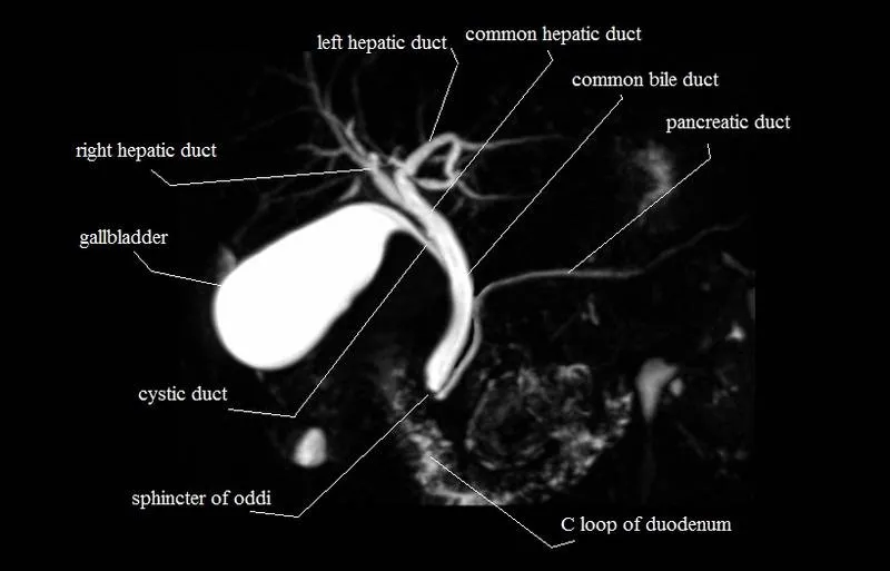 MRI MRCP