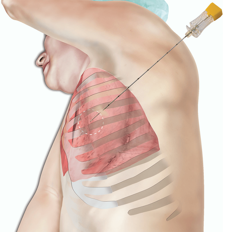 Lung Biopsy In Nagpur