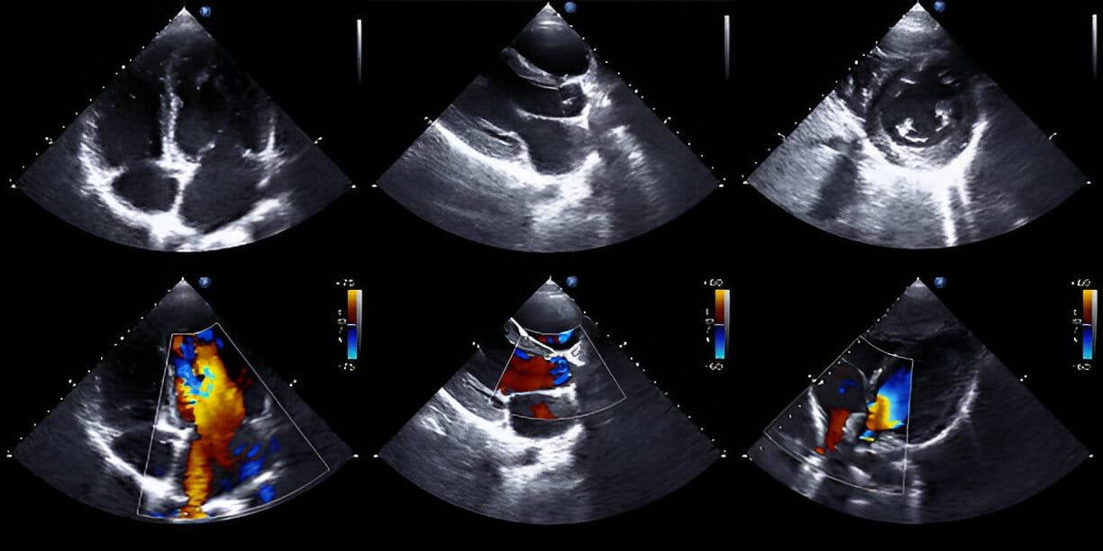 2D ECHO Cardiography