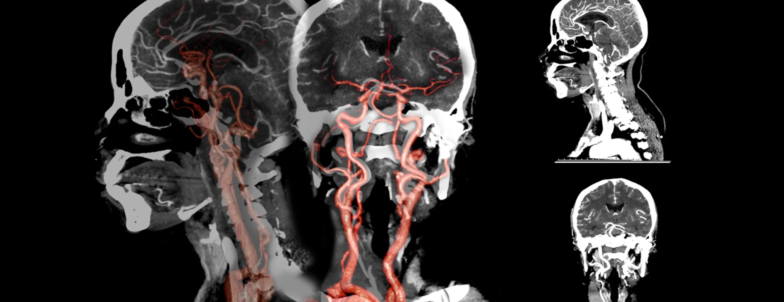 CT Angiography In Nagpur