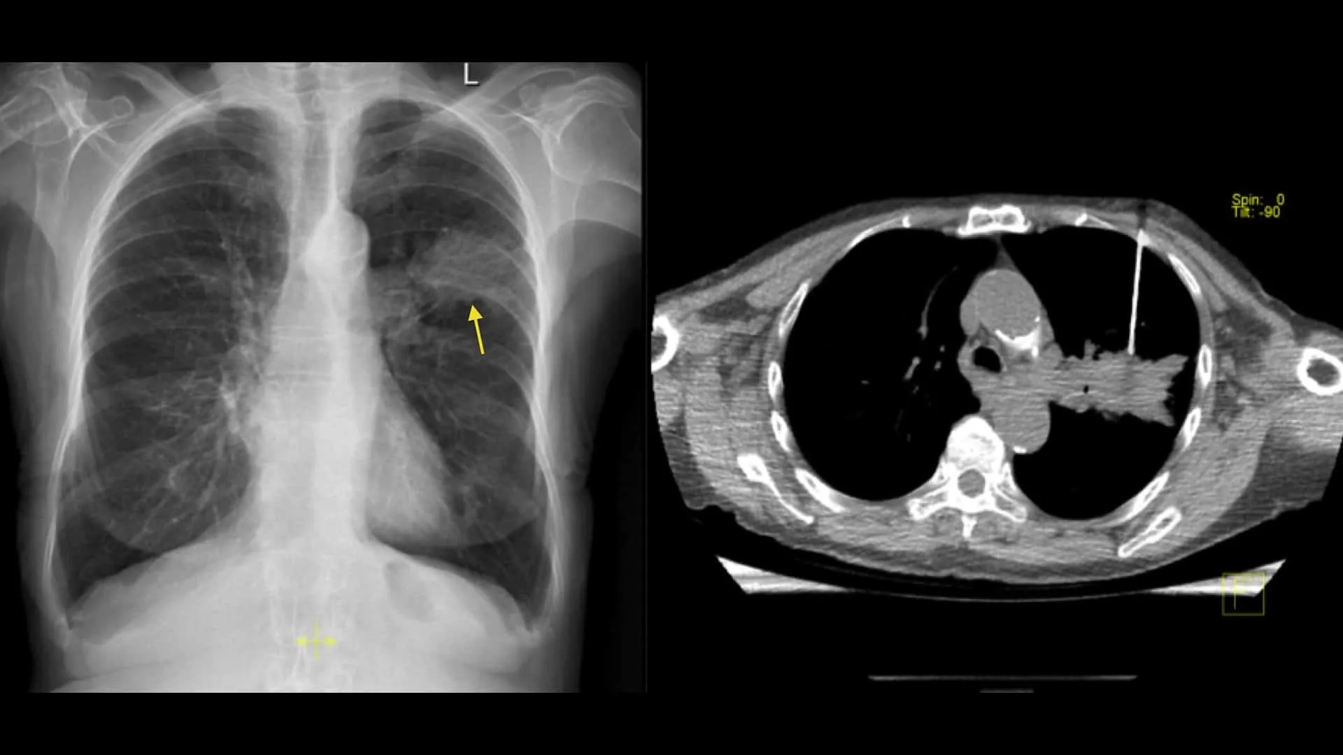 CT Guided Biopsy In Nagpur