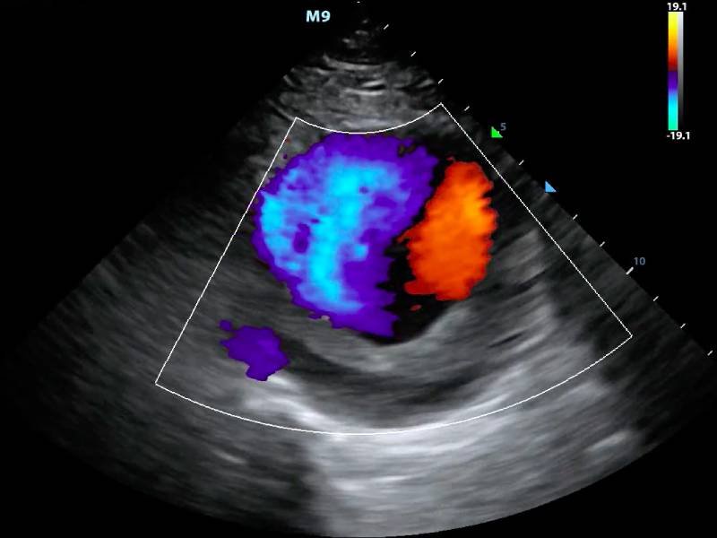Color Doppler Ultrasound In Nagpur