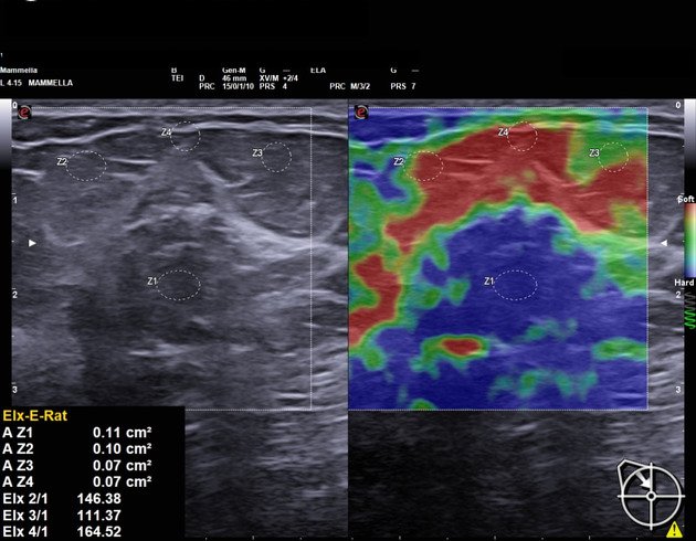 Elastography
