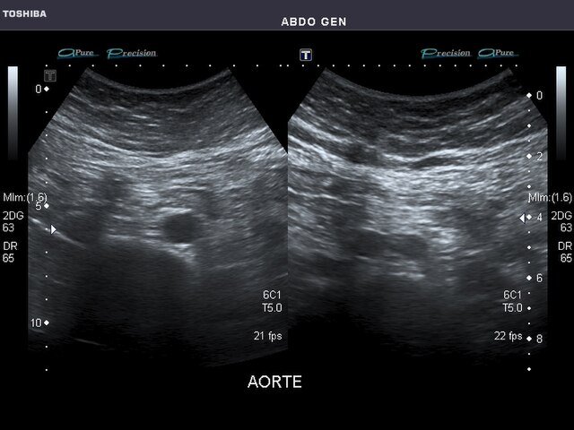 High Resolution Abdominal USG