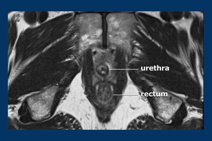 MRI Prostate