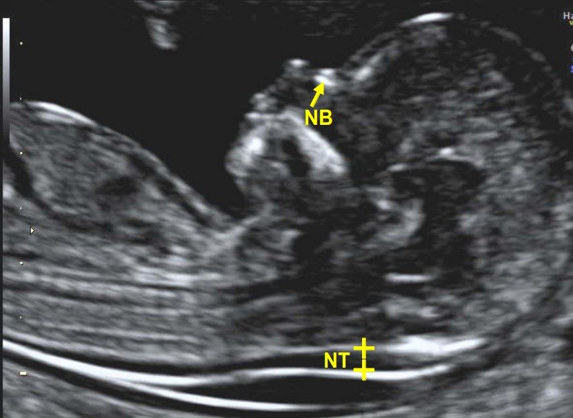 One of the most critical aspects of pregnancy care involves early screening tests, especially the NT/NB scan, which is essential for assessing the health of your baby during the first trimester.