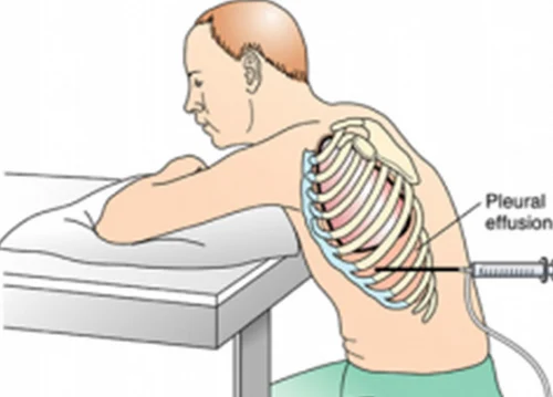Pleural Tapping In Nagpur