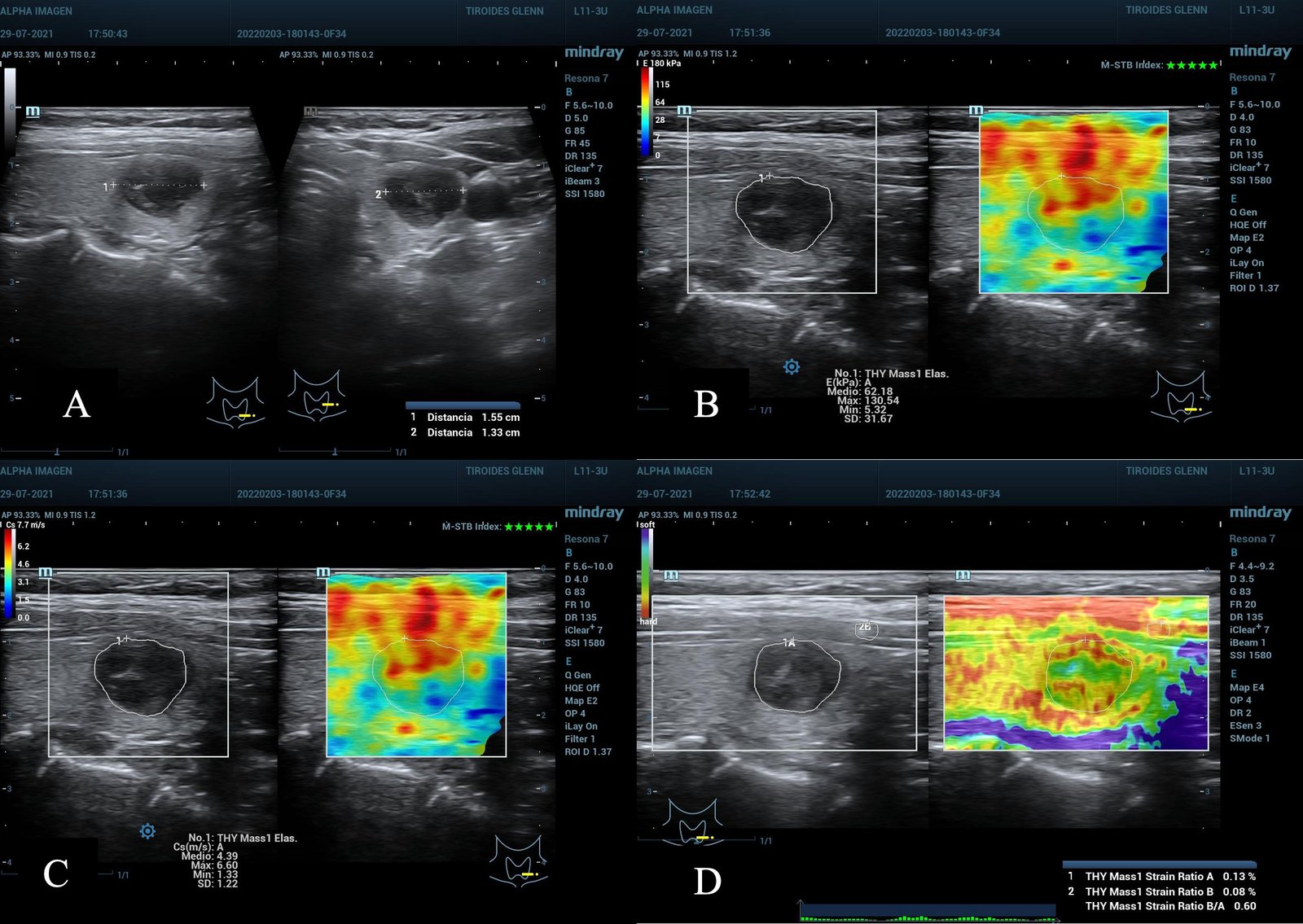 Shear wave / strain elastography for Liver, Breast, Thyroid etc.