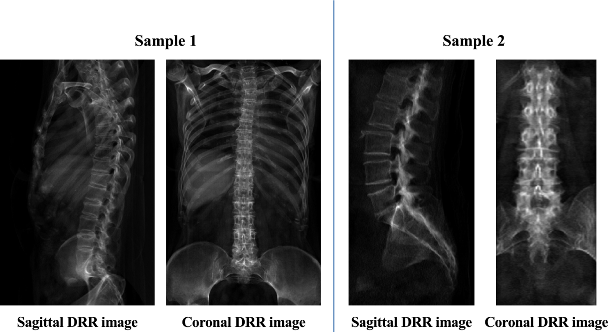 Skeletal and Spine Scanning with Advanced 3D Reconstruction