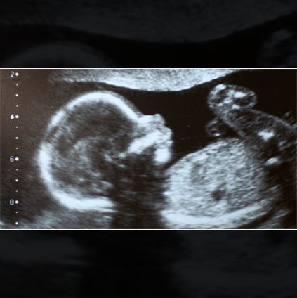 Pregnancy is an exciting journey, filled with anticipation and concerns about the health of the baby.