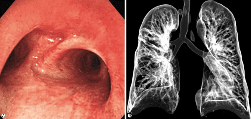 Virtual Bronchoscopy & Colonoscopy