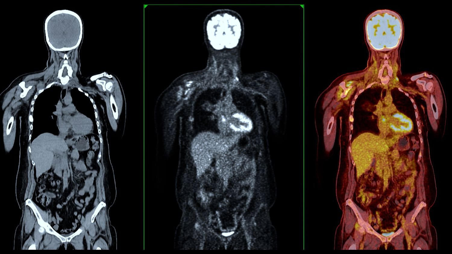 Pet CT Scan In Bhandara